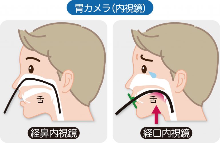 胃 カメラ 怖い