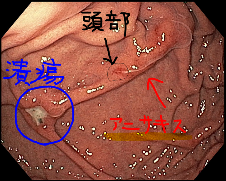 消化器内科専門医が解説 アニサキス症の原因 治療について